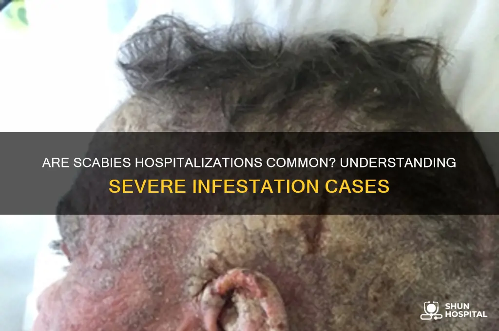are people hospitalized for scabies
