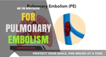 Understanding Pulmonary Embolism: When Does It Require Hospitalization?