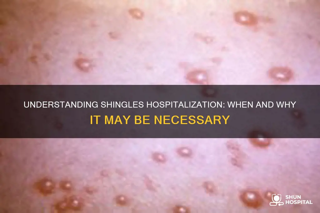are you hospitalized for shingles