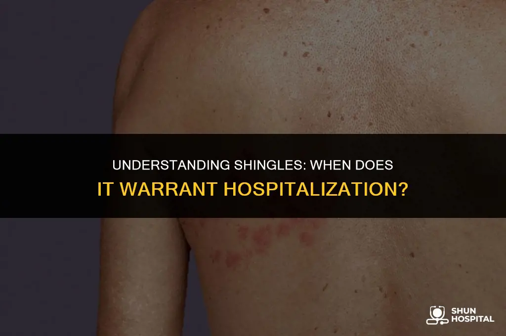 do doctors hospitalize peope for shingles