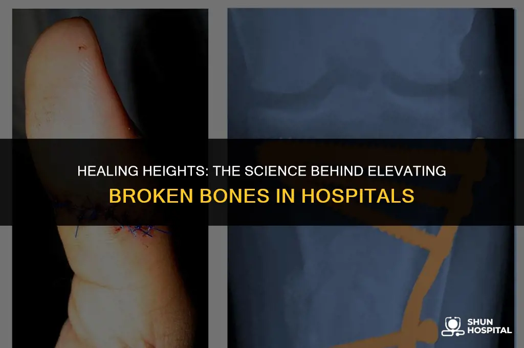 do hospitals keep broken bones elevated