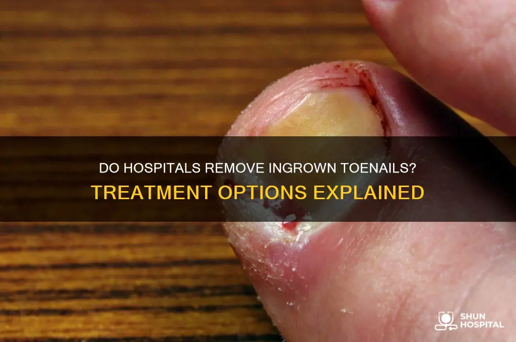 do hospitals remove ingrown toenails