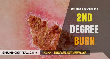 Second-Degree Burn Treatment: When to Seek Hospital Care