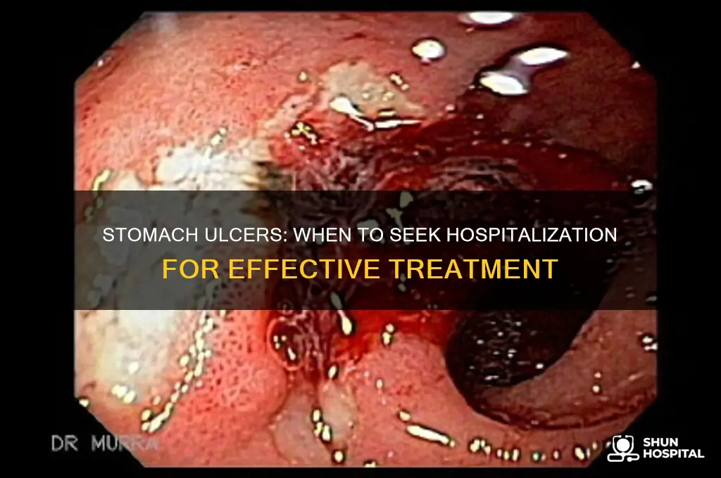 do stomach ulcers require hospitalization