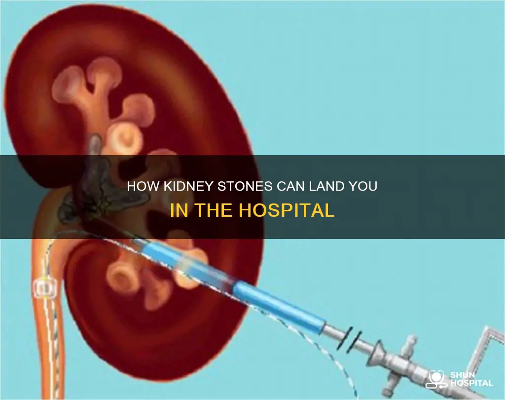 do they hospitalize you for kidney stones