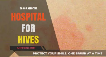 Hospital Visit for Hives: When is it Necessary?