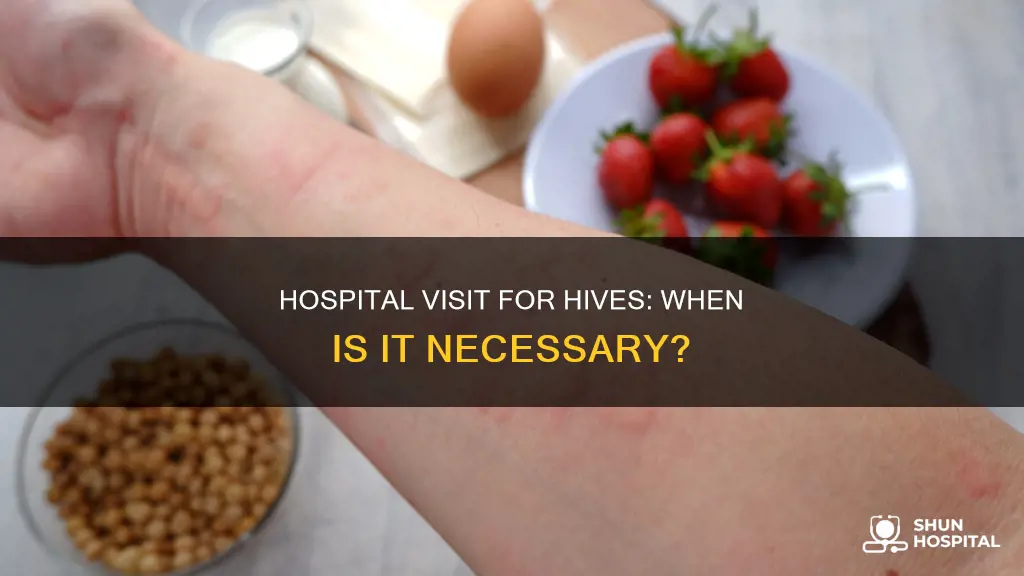 do you need the hospital for hives