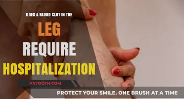 Blood Clot in Leg: When Hospitalization Becomes Necessary