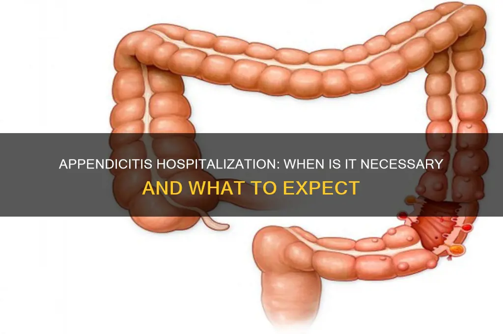 does appendicitis require hospitalization