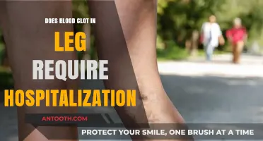 Leg Blood Clots: When Hospitalization is Necessary