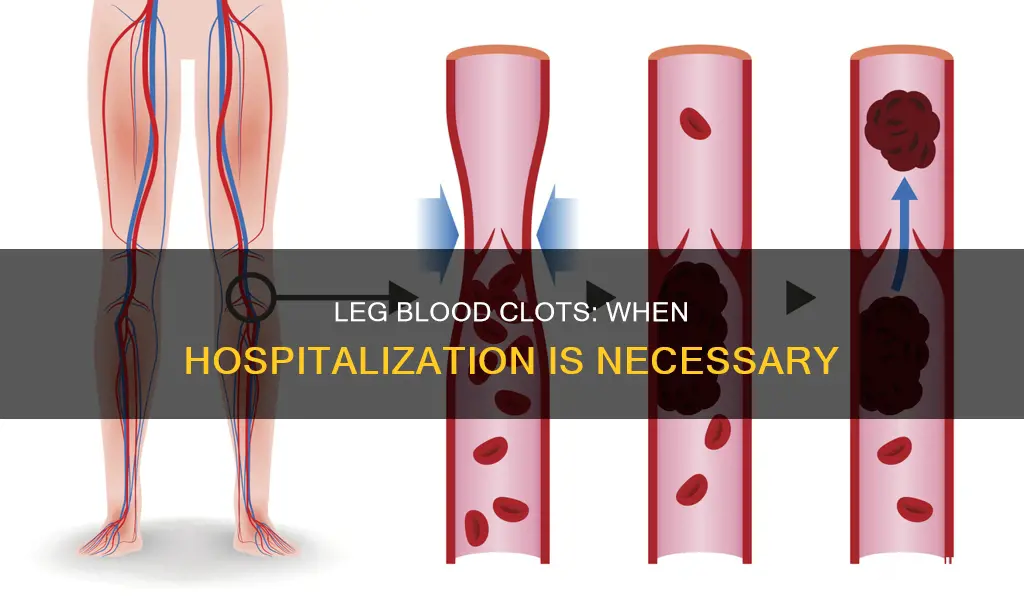 does blood clot in leg require hospitalization