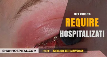 Cellulitis Hospitalization: When Is It Necessary and Why?