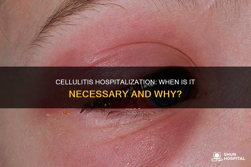 does cellulitis require hospitalization
