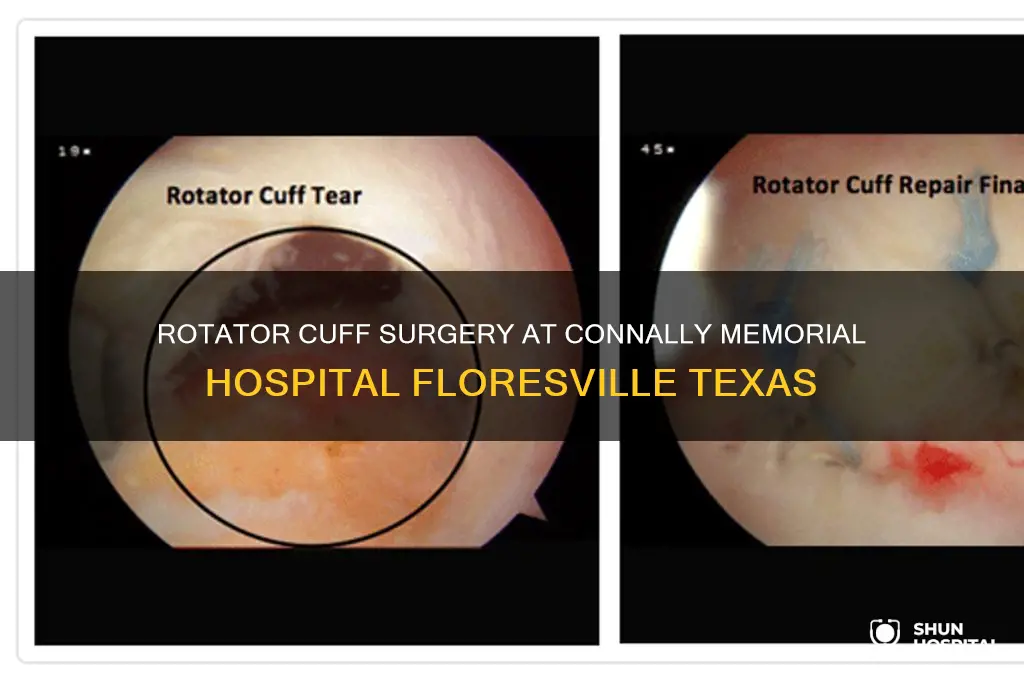 does connally memorial hospital floresville texas do rotator shoulder surgery