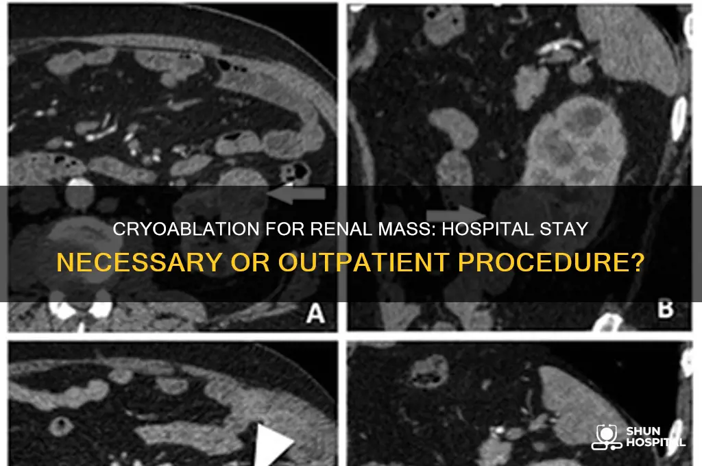 does cryoablation for renal mass require a hospital stay
