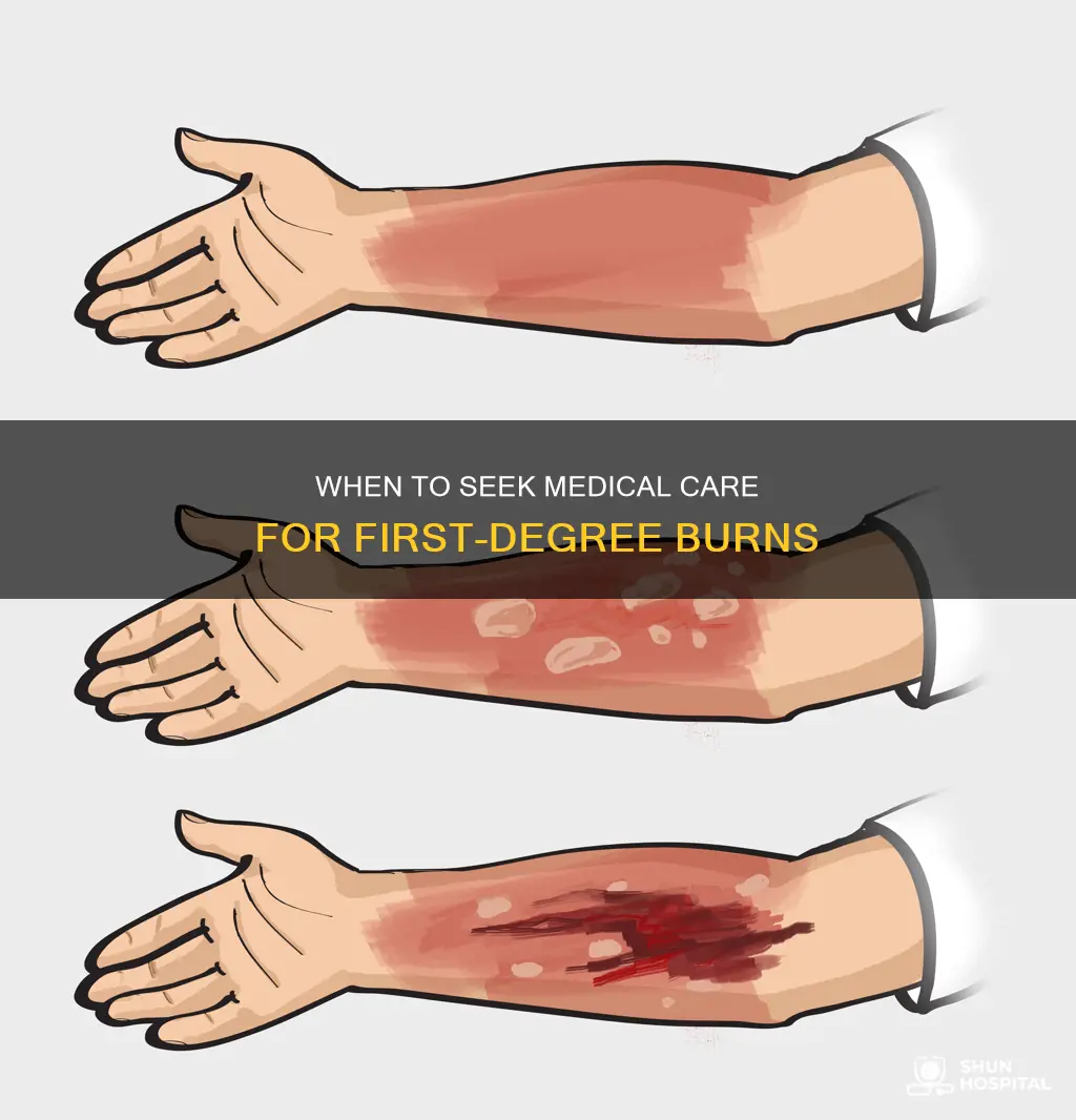 does first degree burn need hospital attention