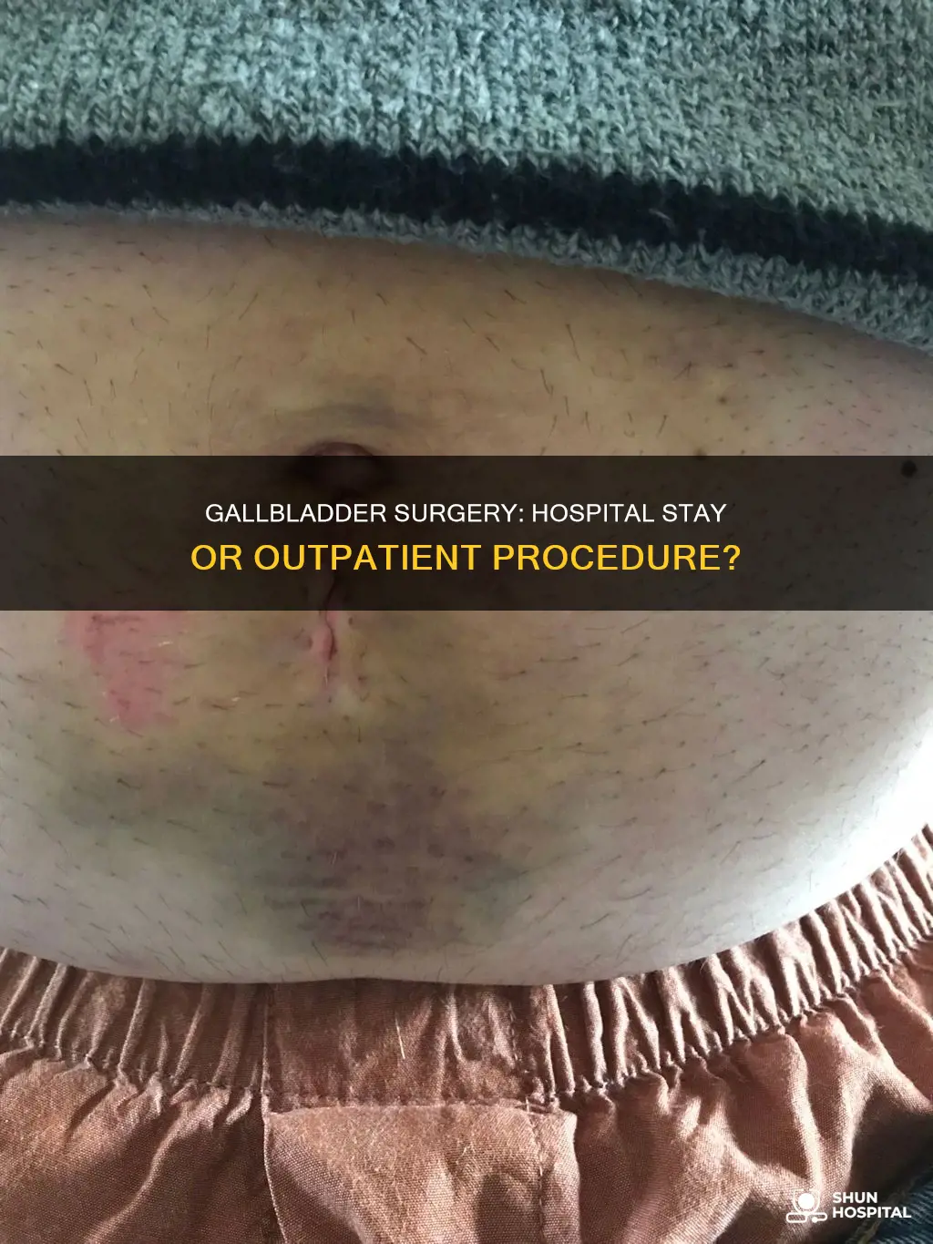 does gallbladder surgery require a hospital stay