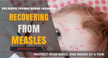Hospital Treatment: Key to Boosting Measles Recovery Chances?