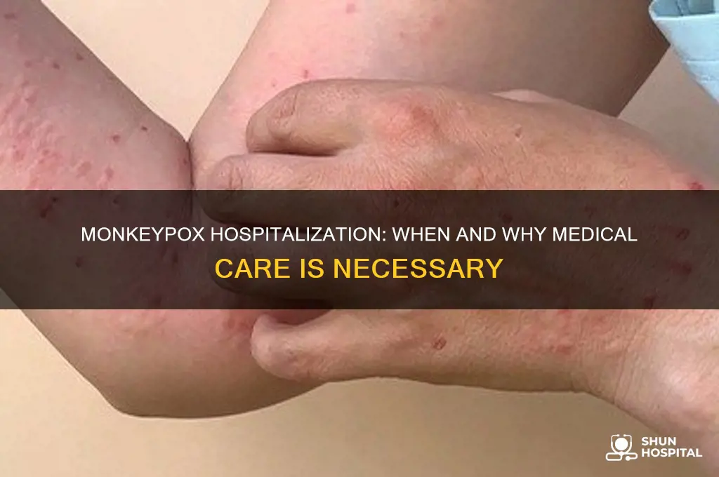 does monkeypox require hospitalization