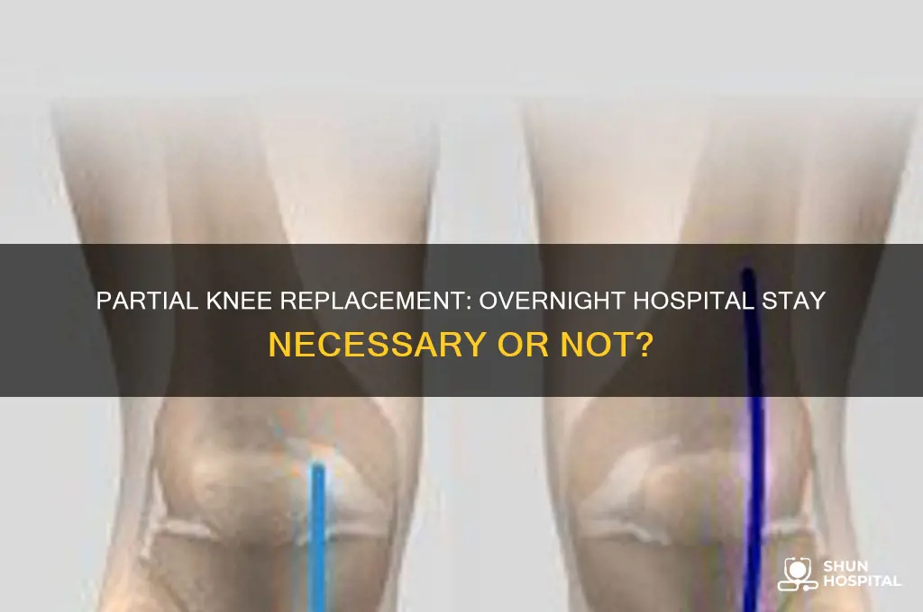 does partial knee replacement require an overnight hospital stay