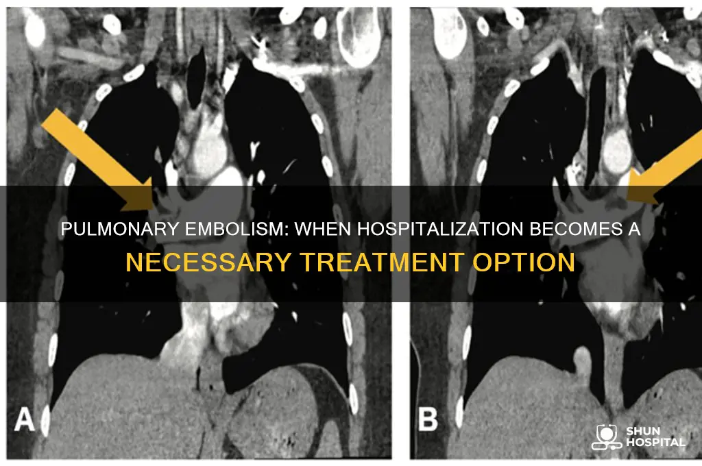 does pulmonary embolism require hospitalization