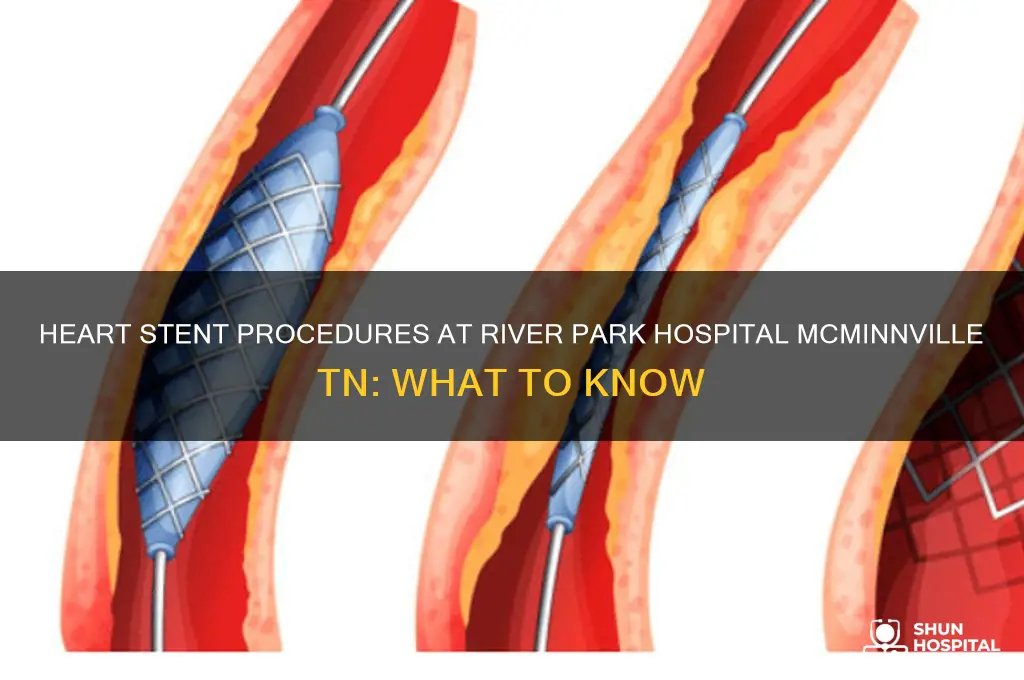 does river park hospital mcminnville tn do heart stent procedures