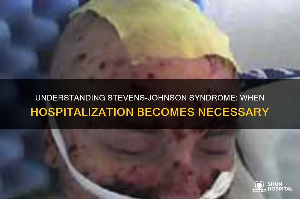 does sjs require hospitalization