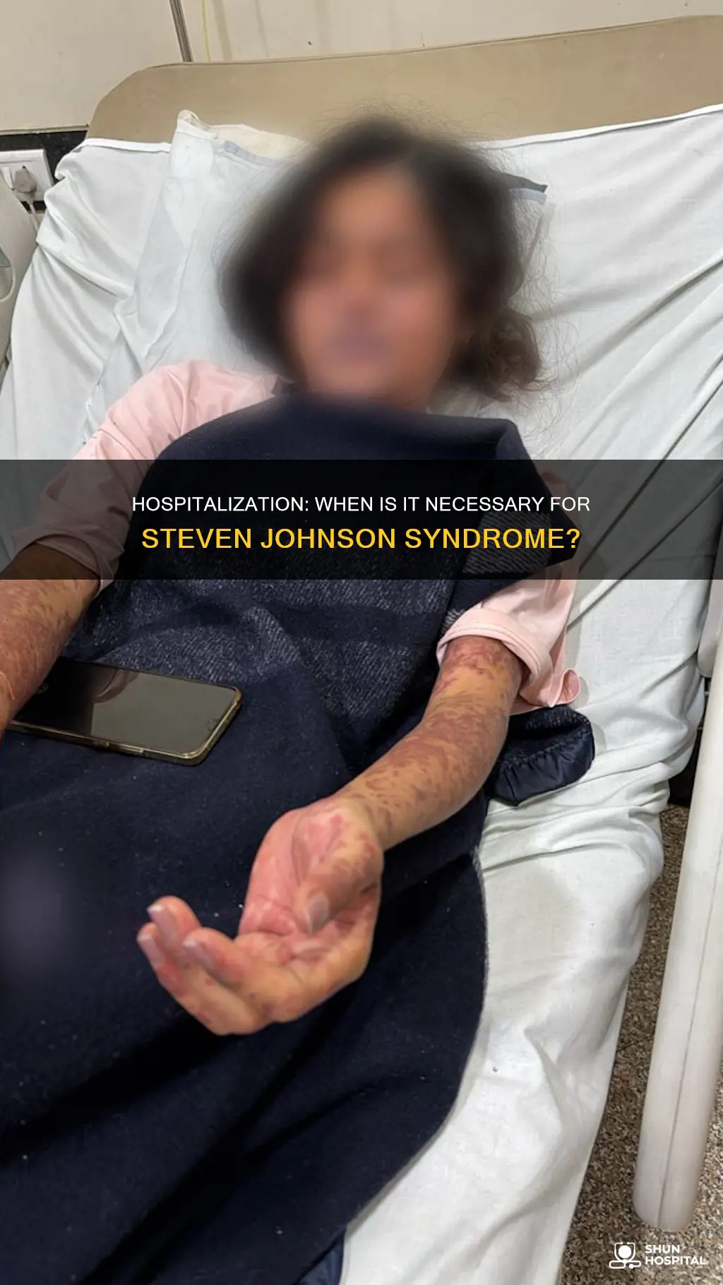 does steven johnson syndrome always require hospitalization