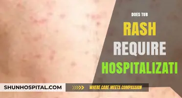 Tub Rash: When to Seek Hospital Care or Treat at Home