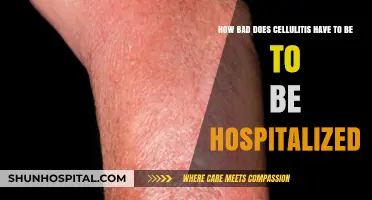 When Cellulitis Requires Hospitalization: Recognizing Severe Symptoms and Risks