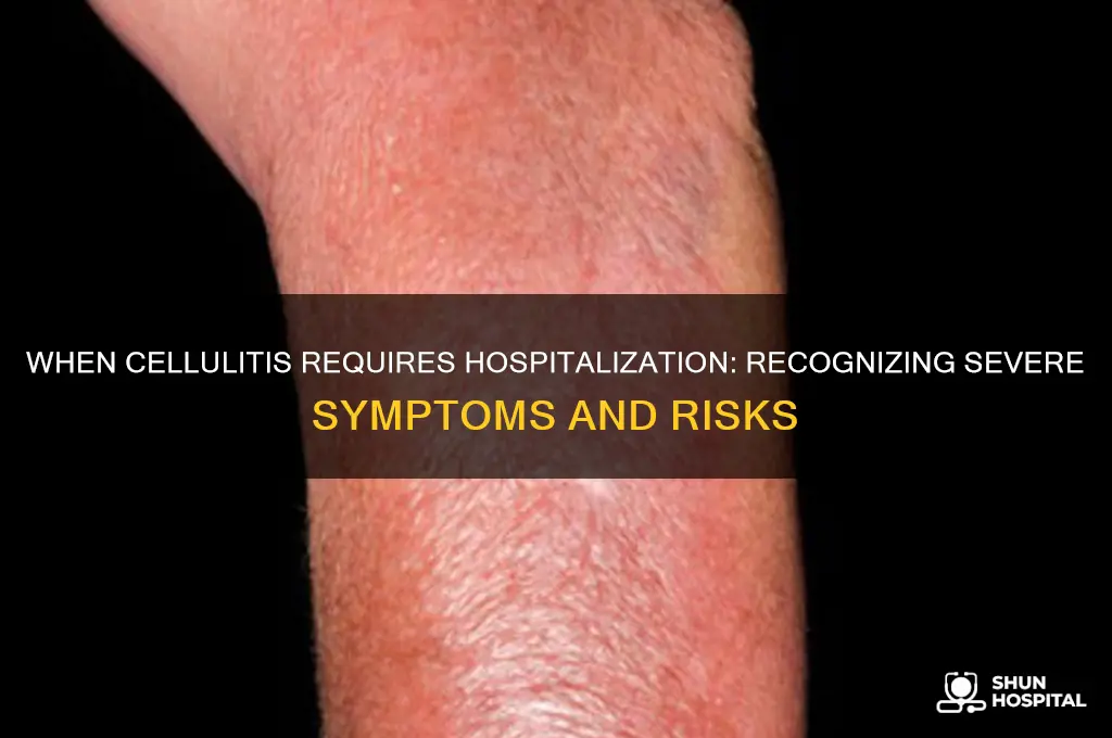 how bad does cellulitis have to be to be hospitalized