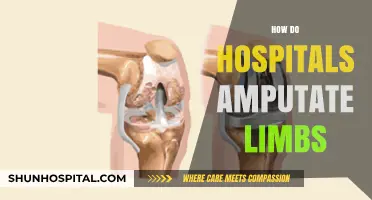 Understanding Limb Amputation: Hospital Procedures, Techniques, and Patient Care