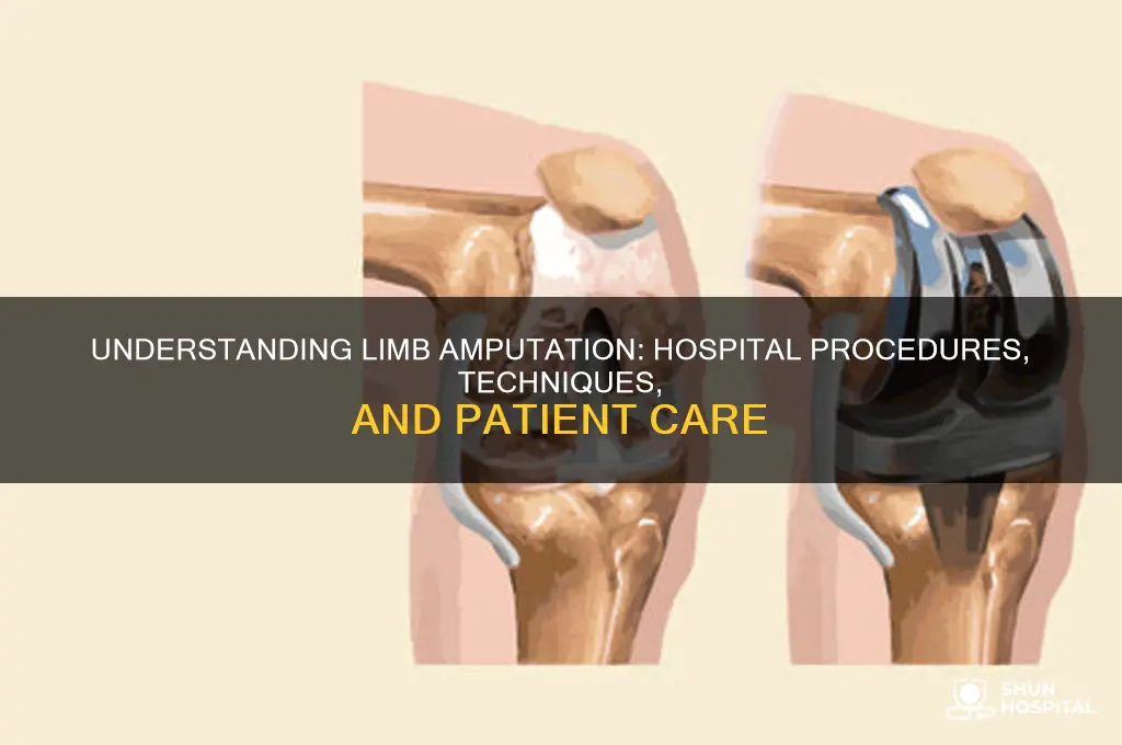 how do hospitals amputate limbs