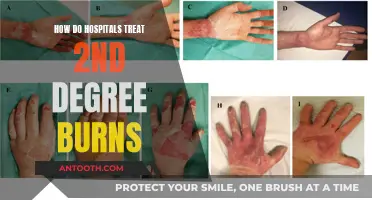 Expert Burn Care: Treating Second-Degree Burns