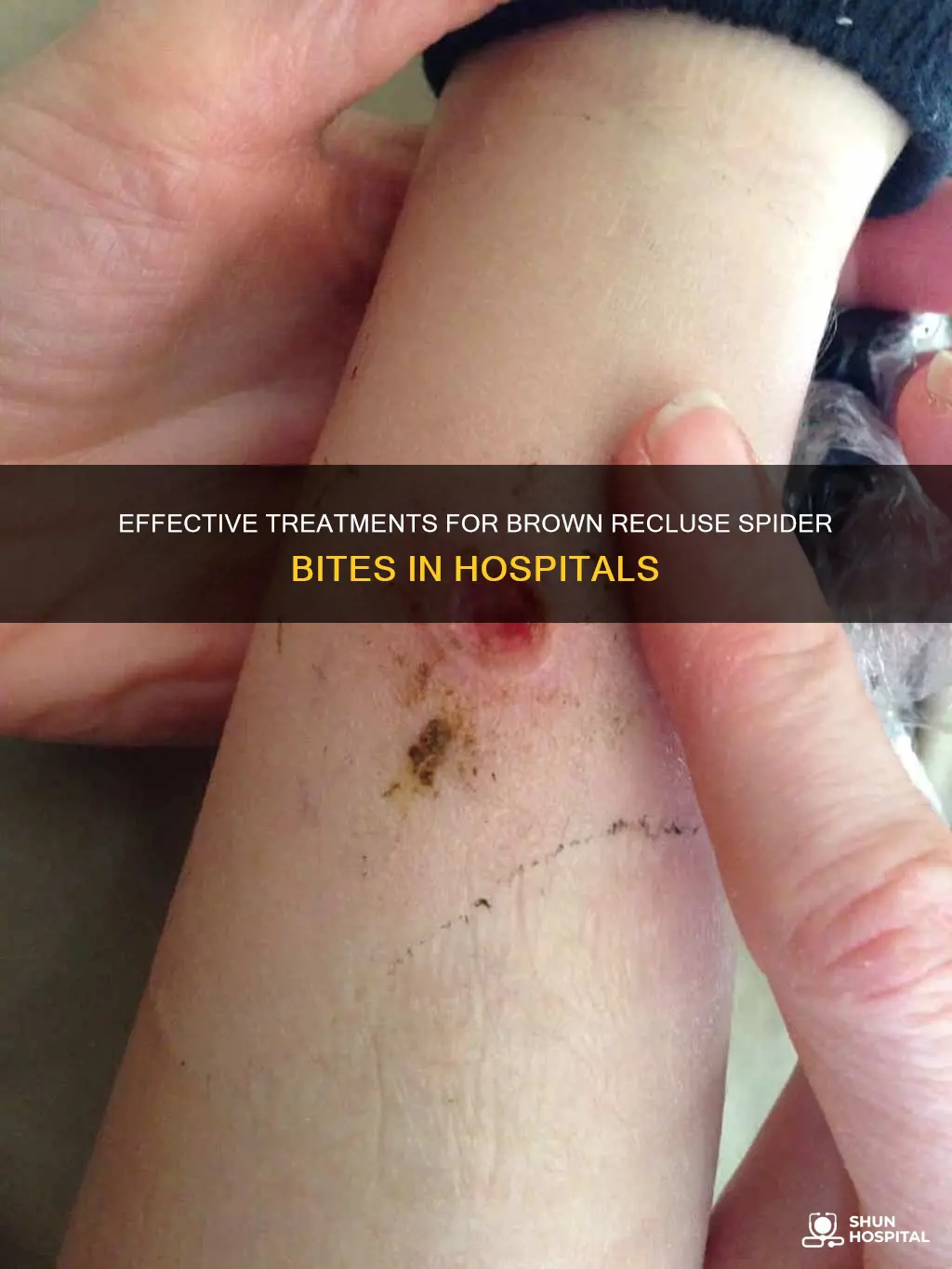 how do hospitals treat brown recluse bites