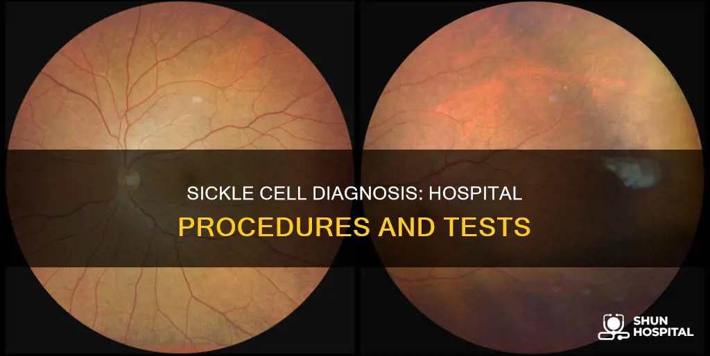 how is sickle cell diagnosed at hospital