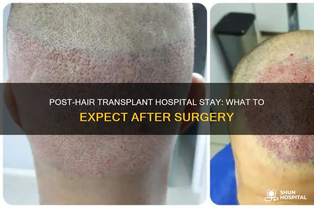 how many days in a hospital after hair transplant