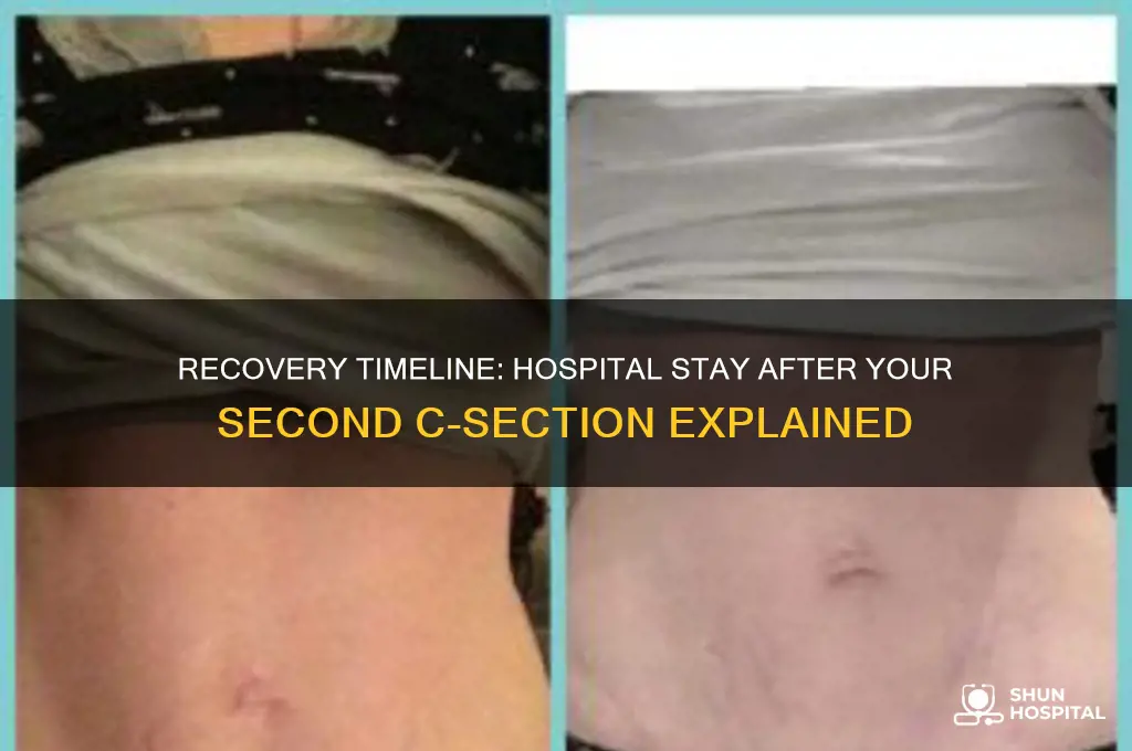 how many days in hospital after 2nd c section