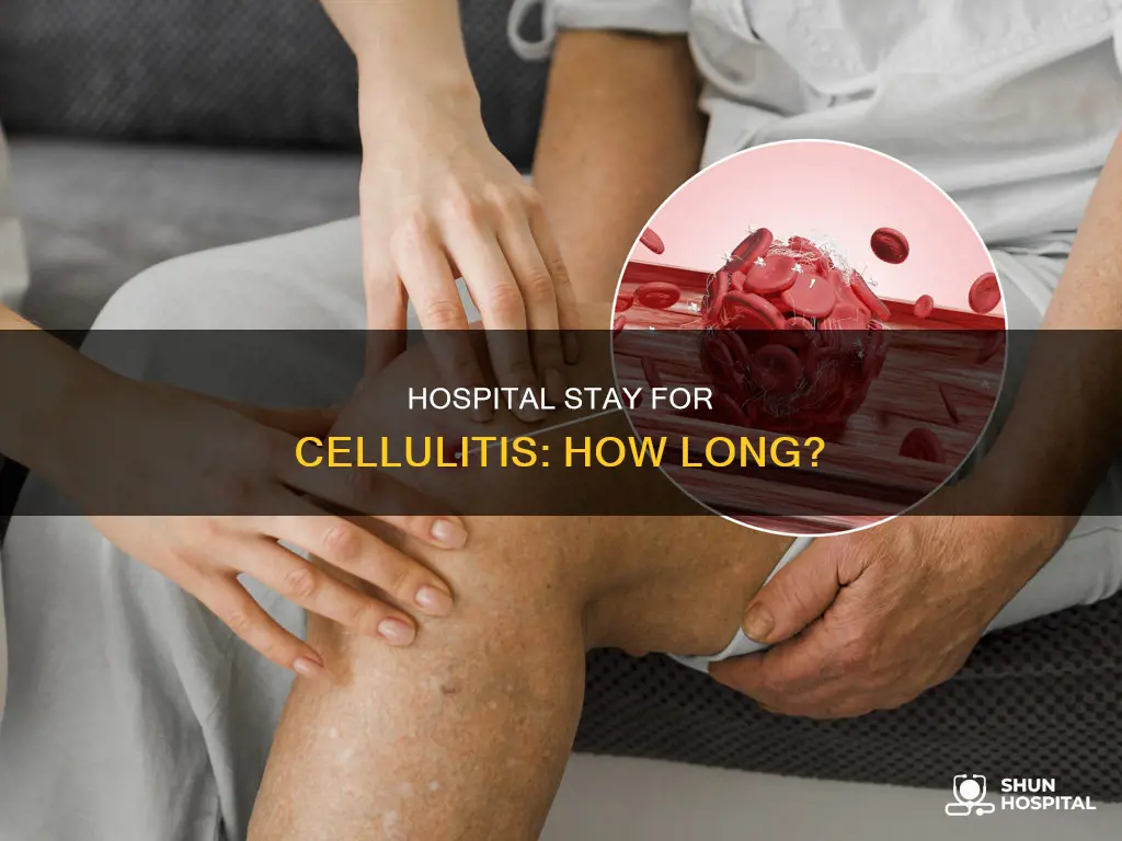 how many days in hospital for cellulitis
