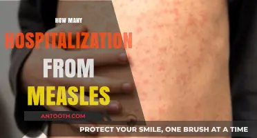 Measles Outbreaks: Understanding Hospitalization Rates and Public Health Impact