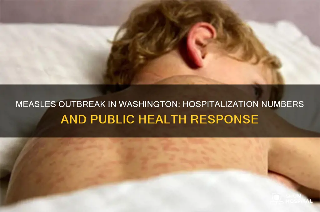 how many people have been hospitalized with measles in washington
