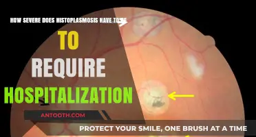 When Histoplasmosis Turns Critical: Hospitalization Thresholds Explained
