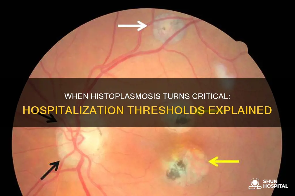 how severe does histoplasmosis have to be to require hospitalization