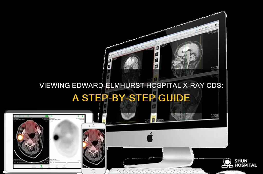 how to view x-ray cd from edward-elmhurst hospital