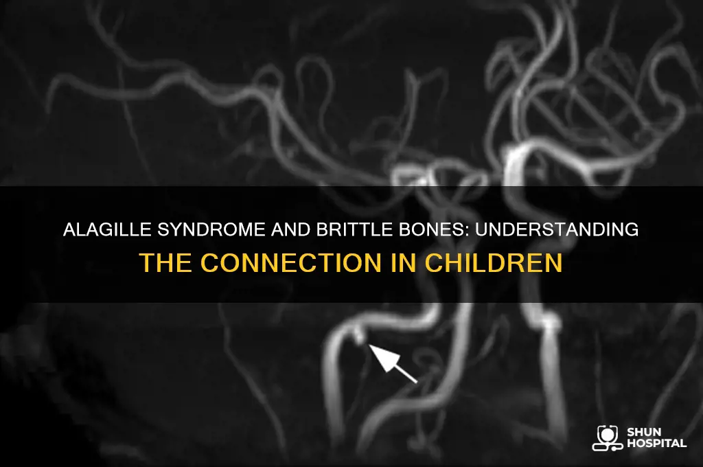 is alagille syndrome a brittle bone diaseae chliderns hospital