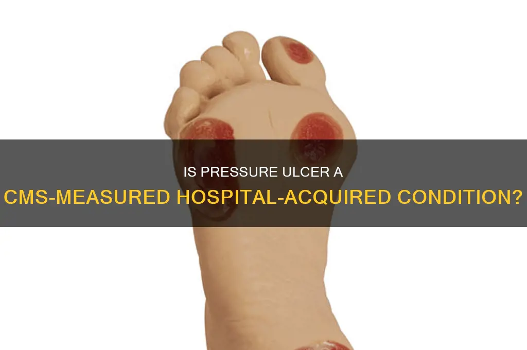 is pressure ulcer a hospital acquire condition meausre by cms