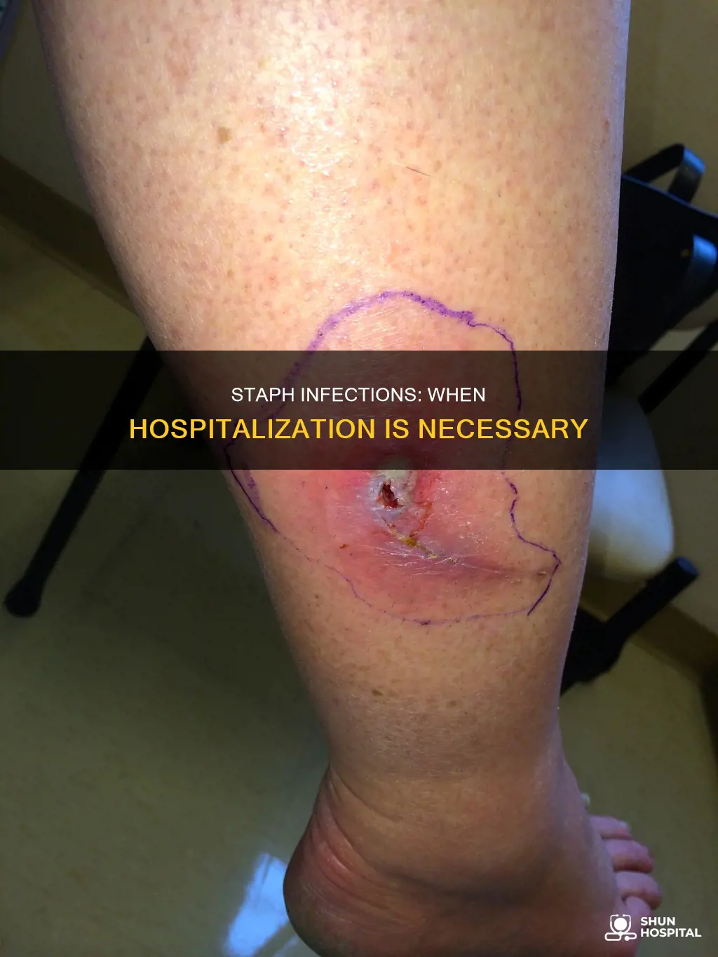 should you be hospitalized for staph infection