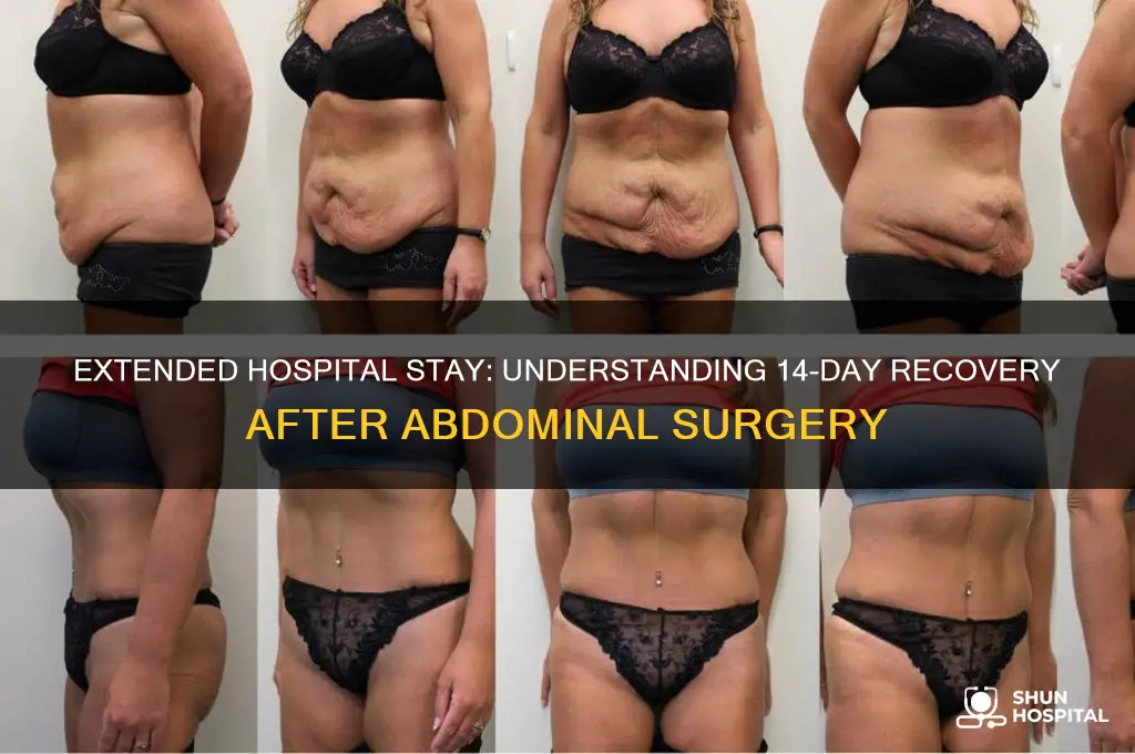 what abdominal surgery keeps you in hospital for 14 days