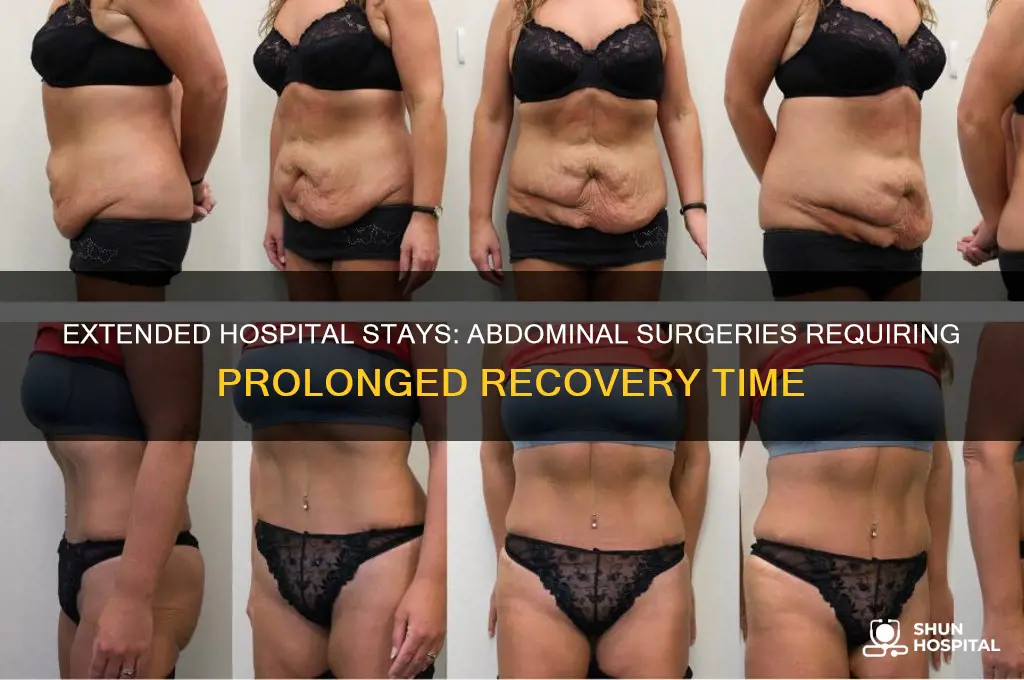 what abdominal surgery would require a lengthy hospital stay