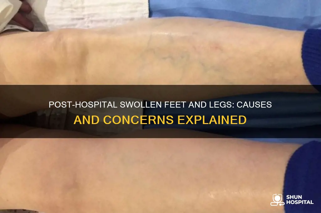 what causes swollen feet and legs after hospital stay